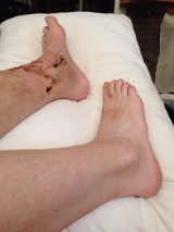 Seventeen stitches on the right-hand ankle. Maybe the left one will look like that in 37 years time ...