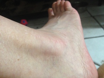 The 38 year-old scar from the ripped ligament (cause, a bad move playing squash ... )