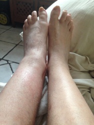 Nearly seven months later, still a swollen left ankle
